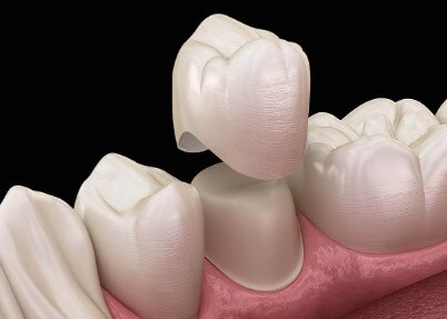 what is a dental crown